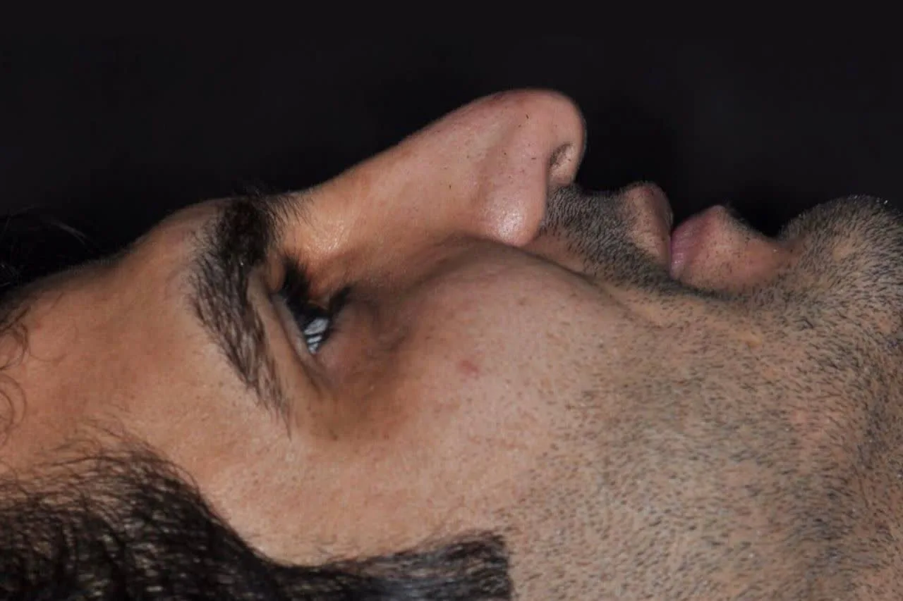جراحی بینی